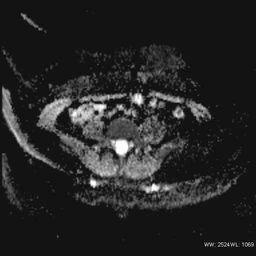 File:Bicornuate uterus- on MRI (Radiopaedia 49206-54297 Axial ADC 3).jpg
