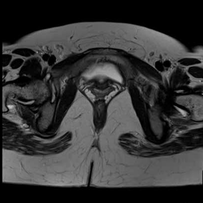 File:Bicornuate uterus (MRI) (Radiopaedia 49206-54297 Axial 37).png