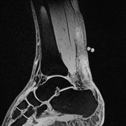 Bilateral Achilles tendon complete tear (Radiopaedia 81344-95051 Sagittal WE - Left 58).jpg