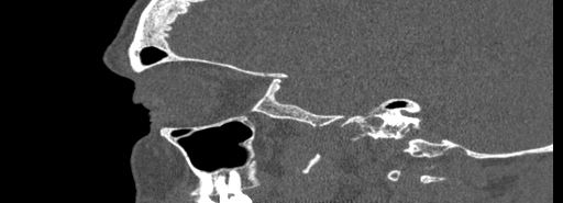 File:Bilateral Ectopic Infraorbital Nerves (Radiopaedia 49006-54084 Sagittal bone window 11).jpg