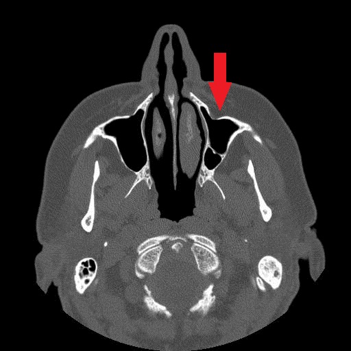 File:Bilateral Ectopic Infraorbital Nerves (Radiopaedia 49006-58325 Axial 1).jpg