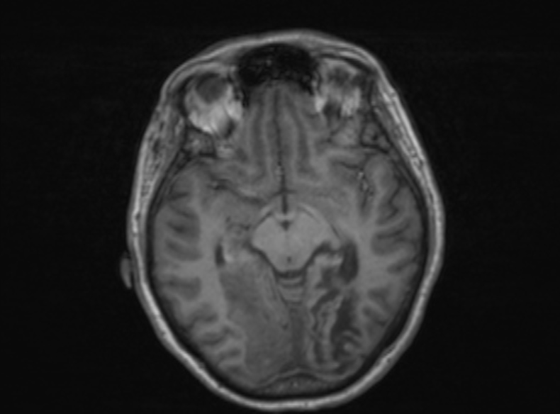 Bilateral PCA territory infarction - different ages (Radiopaedia 46200-51784 Axial T1 259).jpg