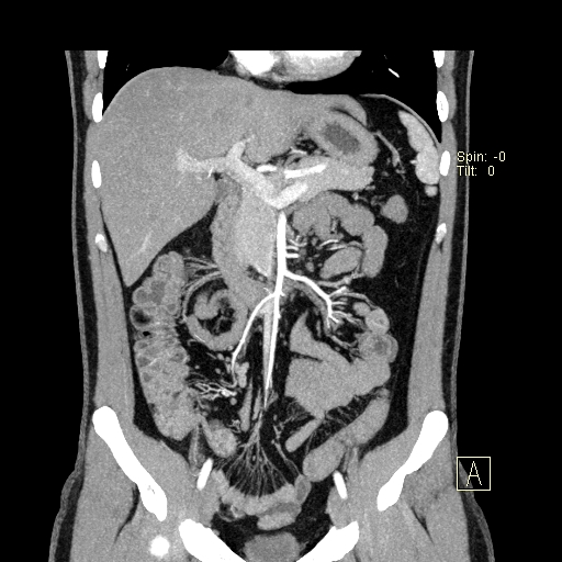 File:Bilateral accessory renal arteries with mild pelvi-ureteric junction (PUJ) obstruction (Radiopaedia 66357-75596 B 8).jpg