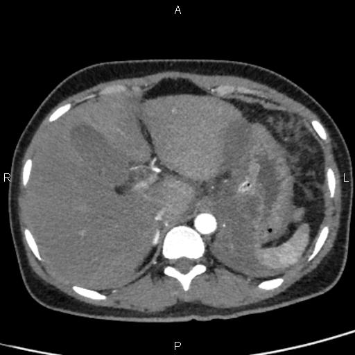 Bilateral adrenal gland hyperenhancement in pancreatitis (Radiopaedia 86642-102753 B 23).jpg