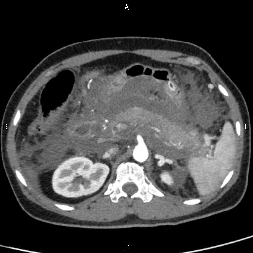 Bilateral adrenal gland hyperenhancement in pancreatitis (Radiopaedia 86642-102753 B 44).jpg