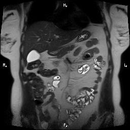 File:Bilateral adrenal myelolipoma (Radiopaedia 63058-71537 Coronal T2 23).jpg