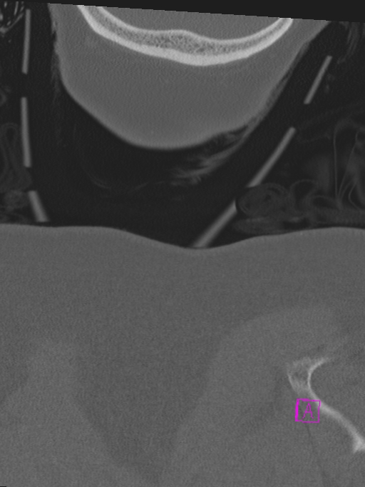 Bilateral atlanto-occipital assimilation (Radiopaedia 28350-28603 Coronal bone window 66).jpg