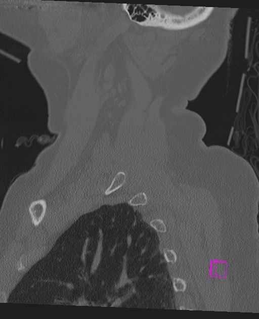 Bilateral atlanto-occipital assimilation (Radiopaedia 28350-28603 Sagittal bone window 68).jpg