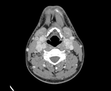 Bilateral carotid body tumors (Radiopaedia 61841-69870 Axial Post contrast 56).jpg