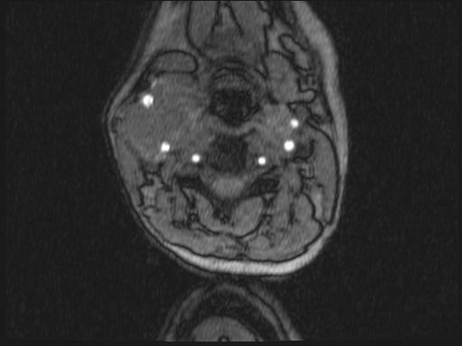 Bilateral carotid body tumors and right glomus jugulare tumor (Radiopaedia 20024-20060 Axial MRA 254).jpg