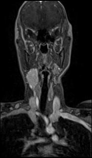 Bilateral carotid body tumors and right glomus jugulare tumor (Radiopaedia 20024-20060 MRA 16).jpg