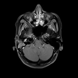 File:Bilateral carotid body tumors and right jugular paraganglioma (Radiopaedia 20024-20060 Axial 110).jpg