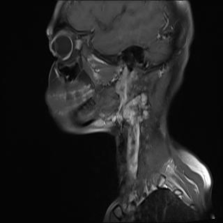 File:Bilateral carotid body tumors and right jugular paraganglioma (Radiopaedia 20024-20060 Sagittal 16).jpg