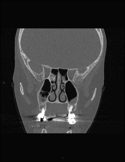 Bilateral frontal mucoceles (Radiopaedia 82352-96454 Coronal 177).jpg