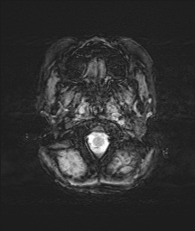 Bilateral mesial temporal polymicrogyria (Radiopaedia 76456-88181 Axial SWI 1).jpg