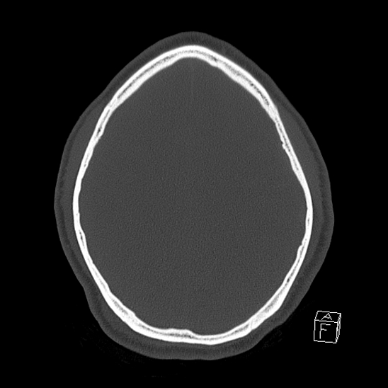 Bilateral occipital condyle fracture (type 2) (Radiopaedia 87675-104089 Axial bone window 98).jpg