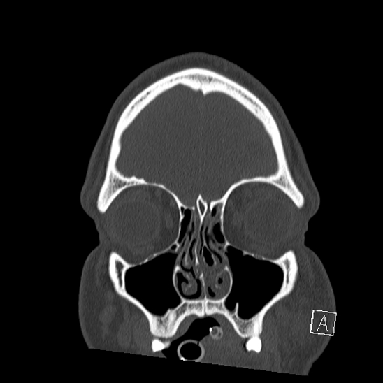 Bilateral occipital condyle fracture (type 2) (Radiopaedia 87675-104089 Coronal bone window 6).jpg
