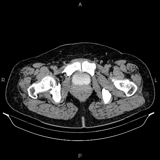 Bilateral ovarian dermoid cysts (Radiopaedia 85785-101603 Axial C+ delayed 88).jpg