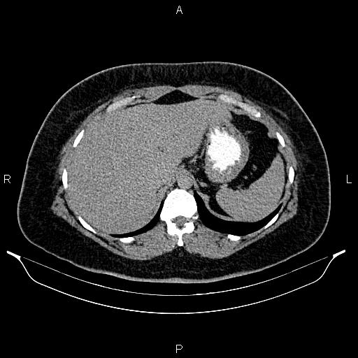 Bilateral ovarian dermoid cysts (Radiopaedia 85785-101603 Axial C+ delayed 9).jpg
