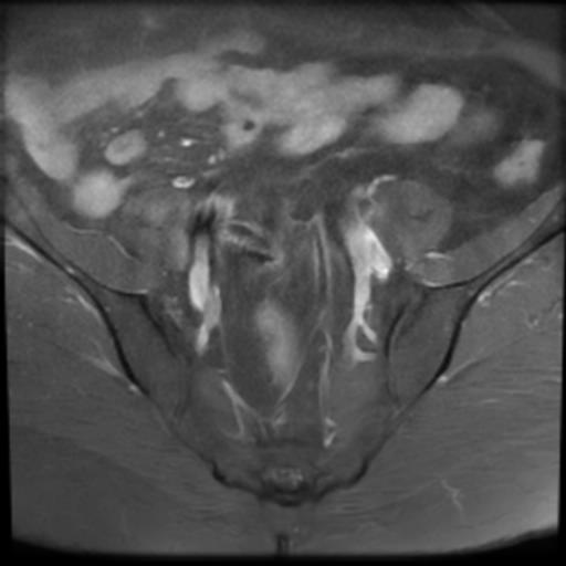 File:Bilateral ovarian dermoid cysts (Radiopaedia 90152-107338 Axial T1 C+ fat sat 5).jpg