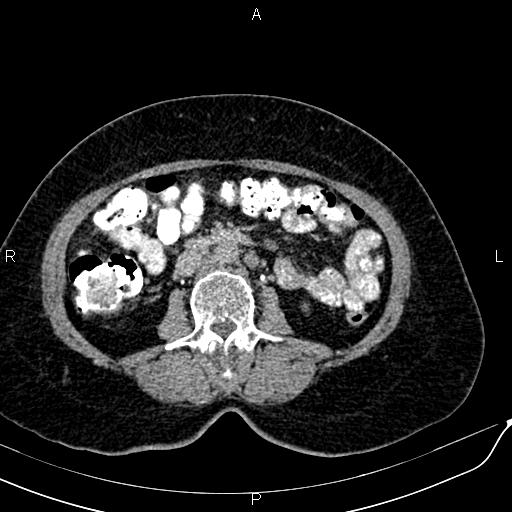 Bilateral ovarian serous cystadenocarcinoma (Radiopaedia 86062-101989 Axial C+ delayed 33).jpg