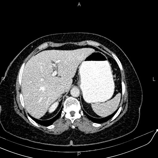 Bilateral ovarian serous cystadenocarcinoma (Radiopaedia 86062-101989 B 22).jpg