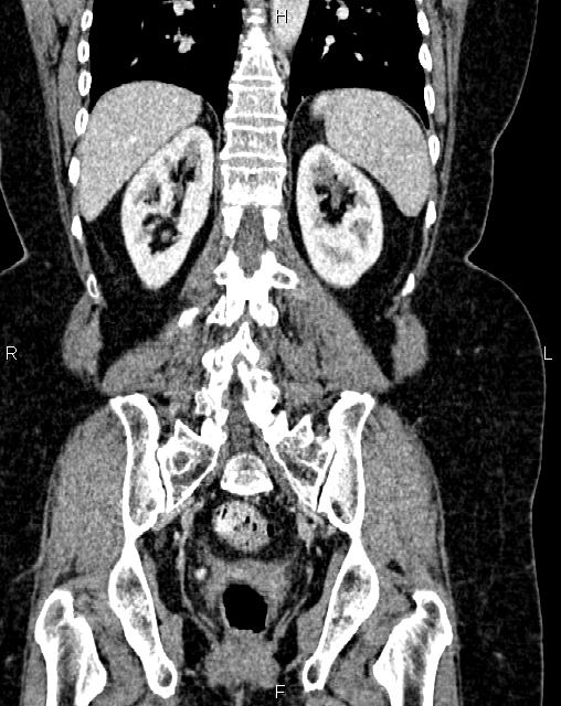Bilateral ovarian serous cystadenocarcinoma (Radiopaedia 86062-101989 D 37).jpg