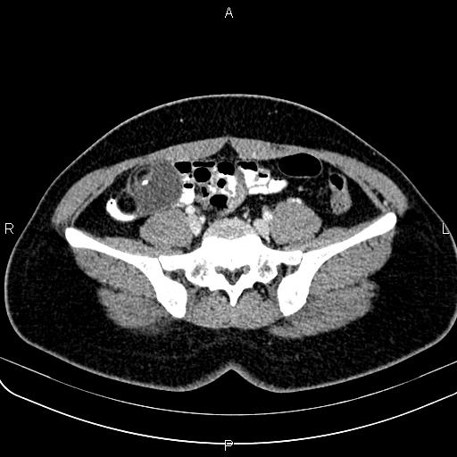 Bilateral ovarian teratoma (Radiopaedia 83131-97503 Axial With contrast 18).jpg