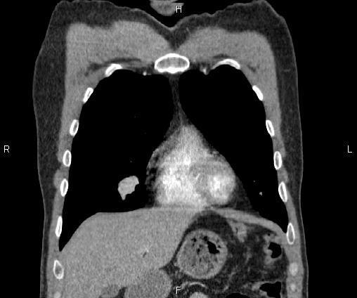 File:Bilateral pulmonary AVM (Radiopaedia 83134-97505 C 20).jpg