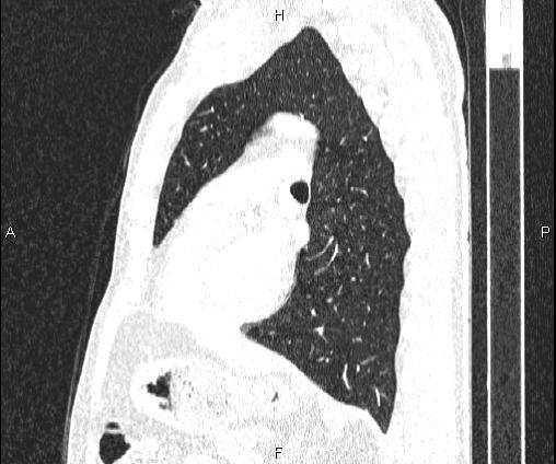 Bilateral pulmonary AVM (Radiopaedia 83134-97505 Sagittal lung window 71).jpg