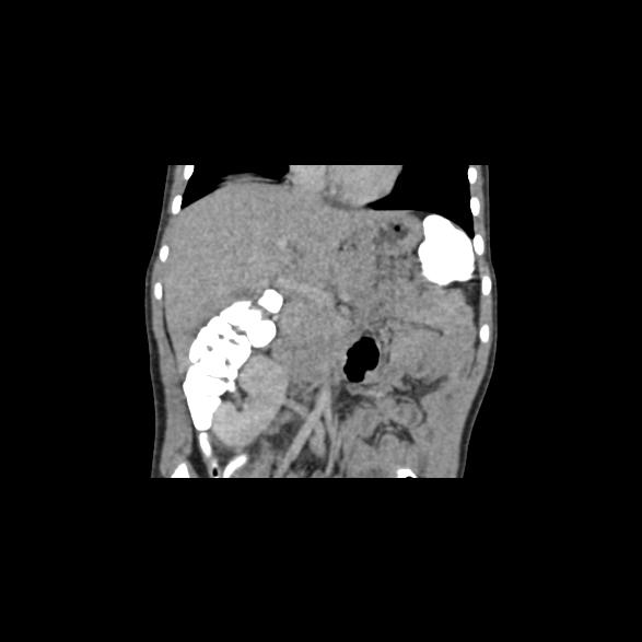 File:Bilateral renal malrotation (Radiopaedia 30901-31606 B 42).jpg