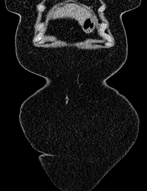 Bilateral staghorn calculi (Radiopaedia 59475-66842 Coronal non-contrast 32).jpg