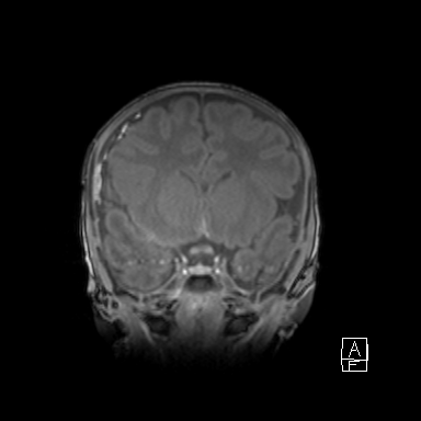 Bilateral subdural hemorrhage and parietal skull fracture (Radiopaedia 26058-26190 Coronal T1 20).png