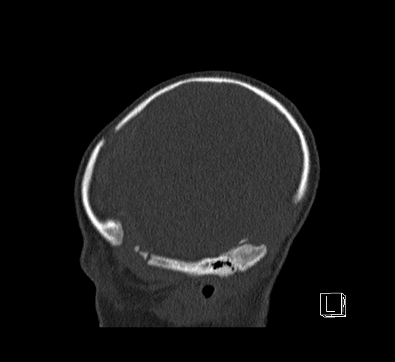 Bilateral subdural hemorrhage and parietal skull fracture (Radiopaedia 26058-26192 Sagittal bone window 14).png