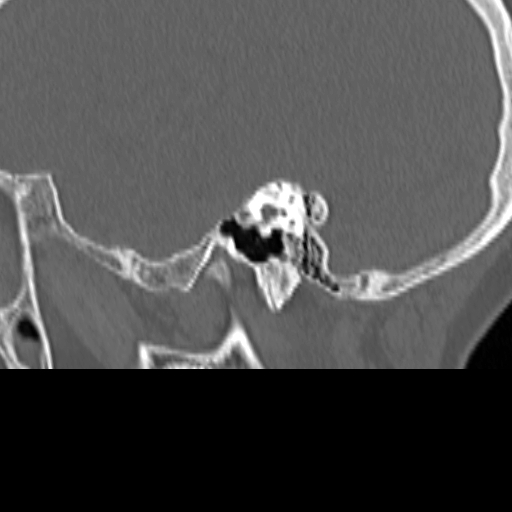 Bilateral tympanoplasty (Radiopaedia 16947-16664 Sagittal bone window 29).jpg