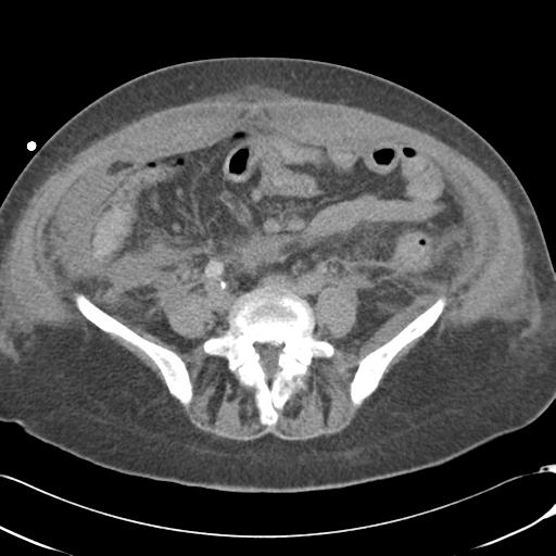 File:Bladder rupture post renal biopsy (Radiopaedia 30863-31572 Axial non-contrast 57).jpg