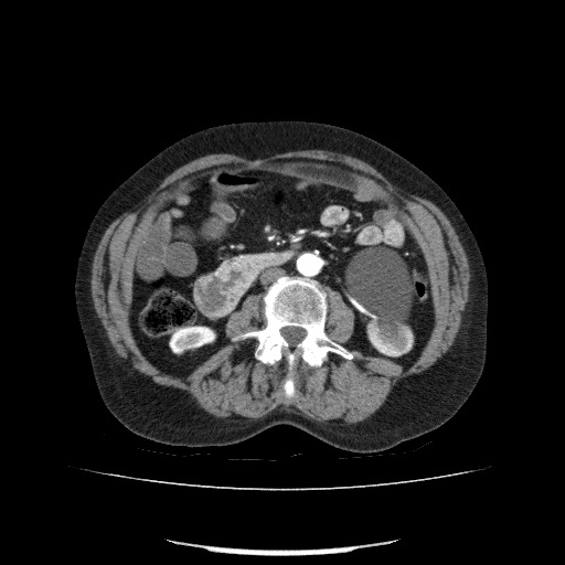 File:Bladder tumor detected on trauma CT (Radiopaedia 51809-57609 A 119).jpg