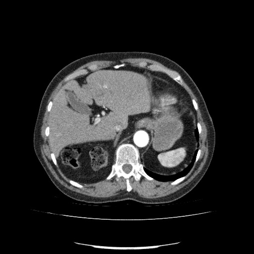 Bladder tumor detected on trauma CT (Radiopaedia 51809-57609 A 81).jpg