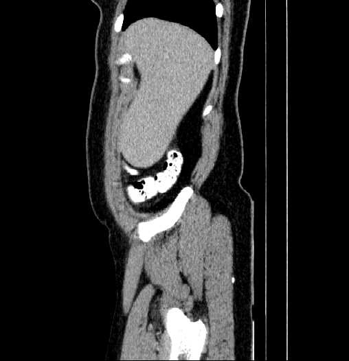 File:Blind-ending branch of a bifid ureter (Radiopaedia 61159-69048 E 3).jpg