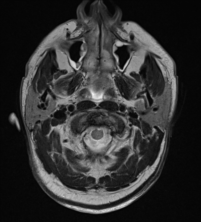 File:Blunt cerebrovascular injury (Radiopaedia 53682-59745 Axial T2 2).png