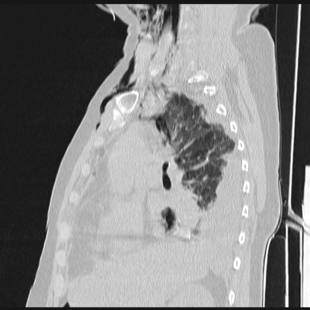 Boerhaave syndrome (Radiopaedia 45644-49799 Sagittal lung window 30).jpg