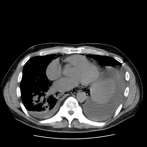 Boerhaave syndrome (Radiopaedia 59796-67310 Axial liver window 40).jpg