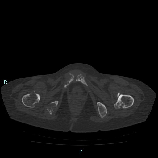 Bone metastases from untreated breast cancer (Radiopaedia 42973-46219 Axial bone window 197).jpg