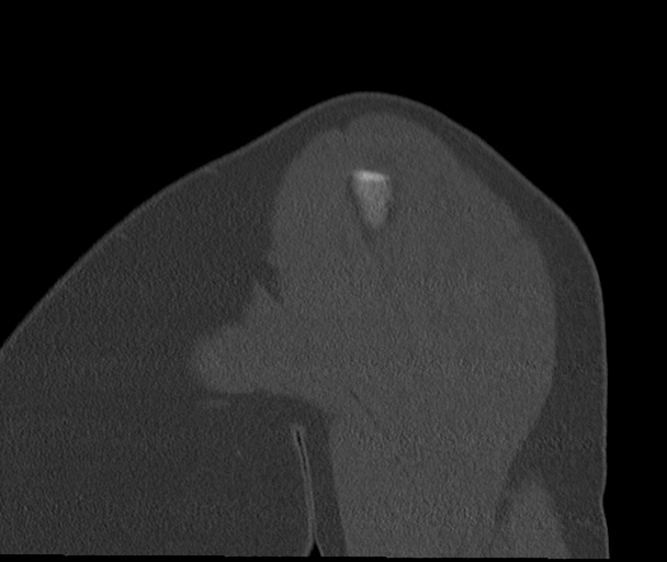 Bony Bankart and Hill-Sachs lesions (Radiopaedia 33622-34727 Sagittal bone window 11).png