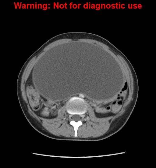 Borderline mucinous cystadenoma of ovary (Radiopaedia 25586-25767 A 24).jpg