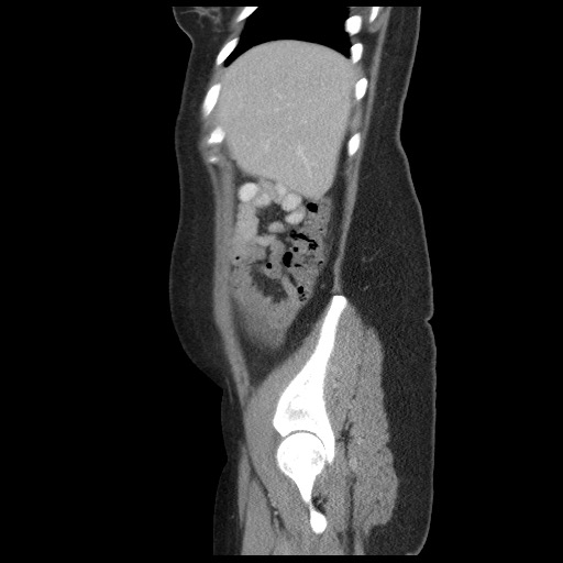 File:Borderline mucinous tumor (ovary) (Radiopaedia 78228-90808 B 16).jpg