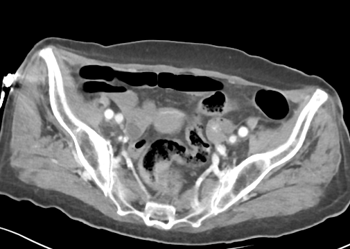 File:Bowel ischemia (Radiopaedia 58273-65382 A 51).png