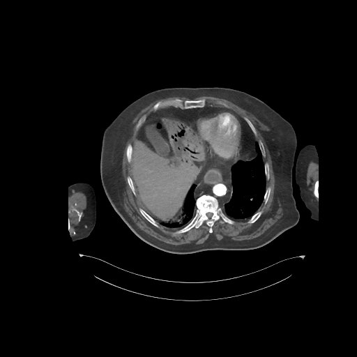 File:Bowel ischemia secondary to SMA occlusion with extensive portomesenteric venous gas (Radiopaedia 54656-60871 A 68).jpg