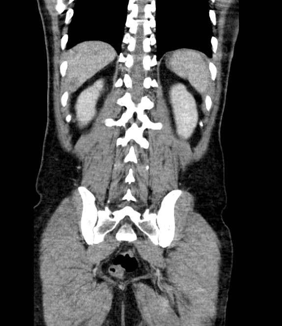 Bowel obstruction from colon carcinoma (Radiopaedia 22995-23028 C 61).jpg