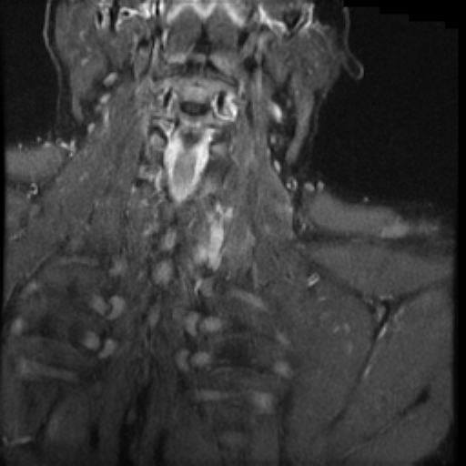 File:Brachial plexus neurofibroma (Radiopaedia 28030-28291 Coronal STIR 3).png
